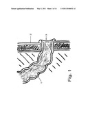 DEVICE FOR A TEMPORARY ILEOSTOMY OR UROSTOMY CLOSURE diagram and image