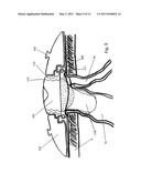 DEVICE FOR A TEMPORARY ILEOSTOMY OR UROSTOMY CLOSURE diagram and image