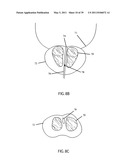 Low-Corrosion Electrode for Treating Tissue diagram and image