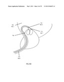 Low-Corrosion Electrode for Treating Tissue diagram and image