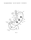 Methods and devices to treat obesity diagram and image