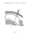 Methods and devices to treat obesity diagram and image