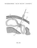 Methods and devices to treat obesity diagram and image