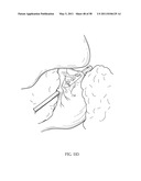 Methods and devices to treat obesity diagram and image