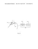 Methods and devices to treat obesity diagram and image