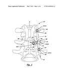 APPARATUS FOR IMPLEMENTING A SPINAL FIXATION SYSTEM WITH SUPPLEMENTAL FIXATION diagram and image