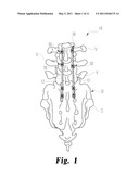 Bone Engaging Implant With Adjustment Saddle diagram and image