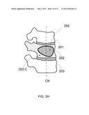 ANTERIOR INFLATION BALLOON diagram and image