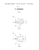 ANTERIOR INFLATION BALLOON diagram and image