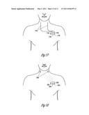 CLOSED LOOP NEURAL STIMULATION SYNCHRONIZED TO CARDIAC CYCLES diagram and image