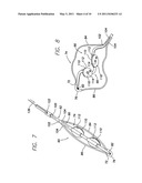 INTRAPERICARDIAL LEAD diagram and image