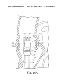 TRANSAPICAL DELIVERY DEVICE AND METHOD OF USE diagram and image