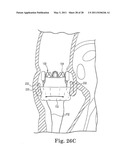 TRANSAPICAL DELIVERY DEVICE AND METHOD OF USE diagram and image