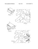 DYNAMIC INTERVERTEBRAL IMPLANT diagram and image