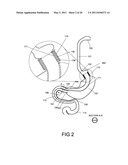 GASTROINTESTINAL PROSTHESES HAVING PARTIAL BYPASS CONFIGURATIONS diagram and image