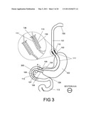 GASTROINTESTINAL PROSTHESES HAVING PARTIAL BYPASS CONFIGURATIONS diagram and image