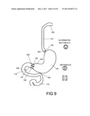 GASTROINTESTINAL PROSTHESES HAVING PARTIAL BYPASS CONFIGURATIONS diagram and image