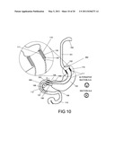 GASTROINTESTINAL PROSTHESES HAVING PARTIAL BYPASS CONFIGURATIONS diagram and image