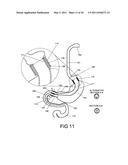 GASTROINTESTINAL PROSTHESES HAVING PARTIAL BYPASS CONFIGURATIONS diagram and image