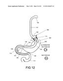 GASTROINTESTINAL PROSTHESES HAVING PARTIAL BYPASS CONFIGURATIONS diagram and image