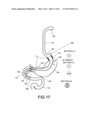 GASTROINTESTINAL PROSTHESES HAVING PARTIAL BYPASS CONFIGURATIONS diagram and image