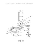 GASTROINTESTINAL PROSTHESES HAVING PARTIAL BYPASS CONFIGURATIONS diagram and image