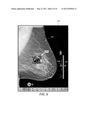 Displaying Computer-Aided Detection Information With Associated Breast Tomosynthesis Image Information diagram and image