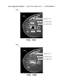 Displaying Computer-Aided Detection Information With Associated Breast Tomosynthesis Image Information diagram and image