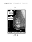 Displaying Computer-Aided Detection Information With Associated Breast Tomosynthesis Image Information diagram and image