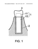 DENTAL IMPLANT diagram and image