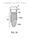 DENTAL IMPLANT diagram and image