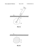 Compositions for Intratumoral Administration diagram and image