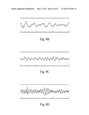 Devices and methods for monitoring physiological information relating to sleep with an implantable device diagram and image