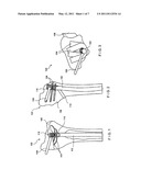 Nail Locking Systems diagram and image