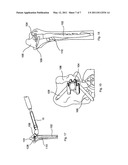 Nail Locking Systems diagram and image