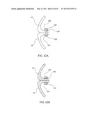 SURGICAL COMPRESSION CLIPS diagram and image