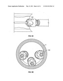 Atherectomy devices and methods diagram and image