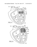 METHOD OF IMPLANTING A PROSTHETIC VALVE IN A MITRAL VALVE WITH PULMONARY VEIN ANCHORING diagram and image