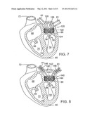 METHOD OF IMPLANTING A PROSTHETIC VALVE IN A MITRAL VALVE WITH PULMONARY VEIN ANCHORING diagram and image