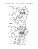 METHOD OF IMPLANTING A PROSTHETIC VALVE IN A MITRAL VALVE WITH PULMONARY VEIN ANCHORING diagram and image