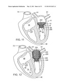 METHOD OF IMPLANTING A PROSTHETIC VALVE IN A MITRAL VALVE WITH PULMONARY VEIN ANCHORING diagram and image