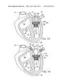 METHOD OF IMPLANTING A PROSTHETIC VALVE IN A MITRAL VALVE WITH PULMONARY VEIN ANCHORING diagram and image