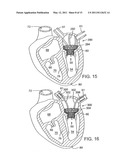 METHOD OF IMPLANTING A PROSTHETIC VALVE IN A MITRAL VALVE WITH PULMONARY VEIN ANCHORING diagram and image