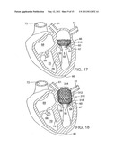 METHOD OF IMPLANTING A PROSTHETIC VALVE IN A MITRAL VALVE WITH PULMONARY VEIN ANCHORING diagram and image