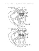 METHOD OF IMPLANTING A PROSTHETIC VALVE IN A MITRAL VALVE WITH PULMONARY VEIN ANCHORING diagram and image