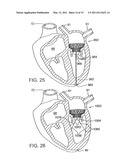 METHOD OF IMPLANTING A PROSTHETIC VALVE IN A MITRAL VALVE WITH PULMONARY VEIN ANCHORING diagram and image