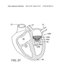 METHOD OF IMPLANTING A PROSTHETIC VALVE IN A MITRAL VALVE WITH PULMONARY VEIN ANCHORING diagram and image