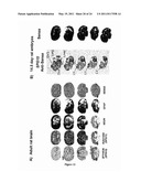 DIAGNOSIS OF HEREDITARY SPASTIC PARAPLEGIAS (HSP) BY IDENTIFICATION OF A MUTATION IN THE ZFYVE26 GENE OR PROTEIN diagram and image