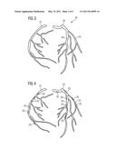 METHOD AND DEVICE FOR IDENTIFYING AND ASSIGNING CORONARY CALCIFICATION TO A CORONARY VESSEL AND COMPUTER PROGRAM PRODUCT diagram and image