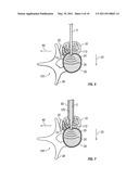 Spinous Navigation System and Associated Methods diagram and image